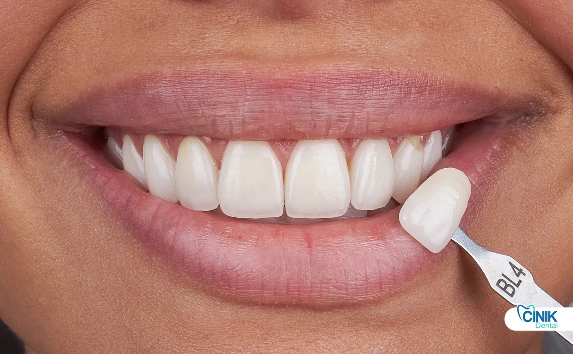 Close-up of a smile showcasing E.max veneers during an aesthetic dentistry consultation.
