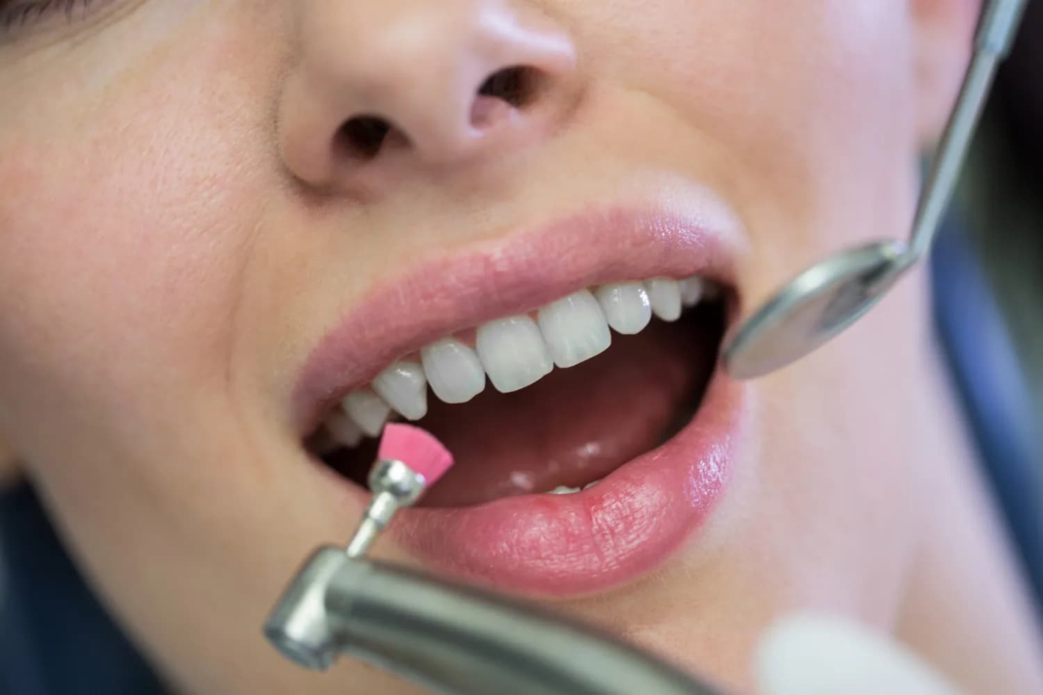 A dentist preparing a patient's teeth for E.max veneers during a consultation.
