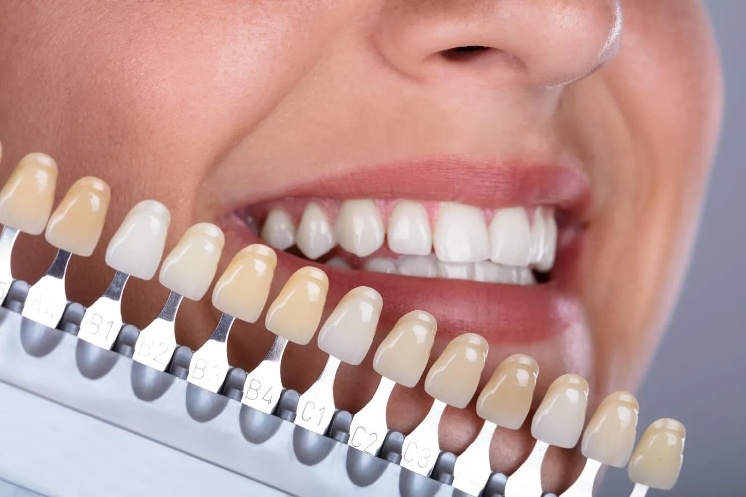Close-up of a smiling woman comparing tooth shade with E.max veneers on a color guide.